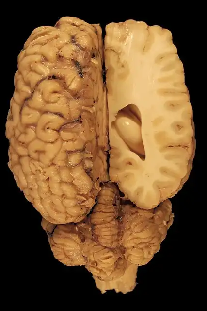 Menopause Brain Changes: Hormones, Gray Matter, and New Research Insights